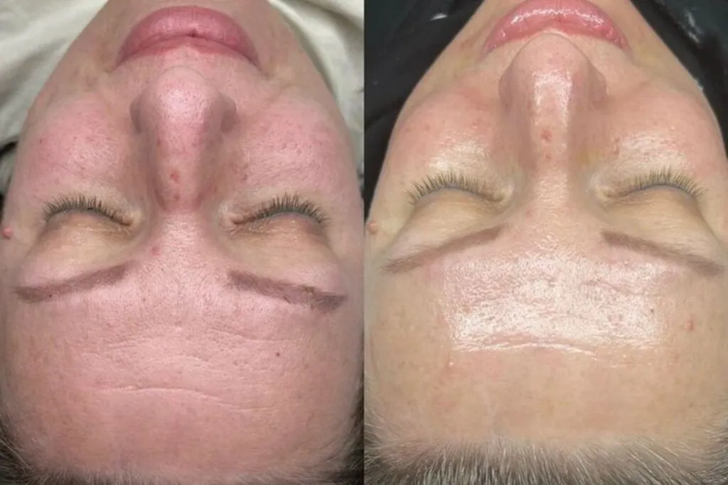 Best treatment for pigmentation before-after results at Paradise Wellness