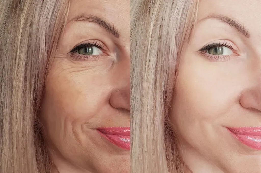 before after Glow Infusion Treatment