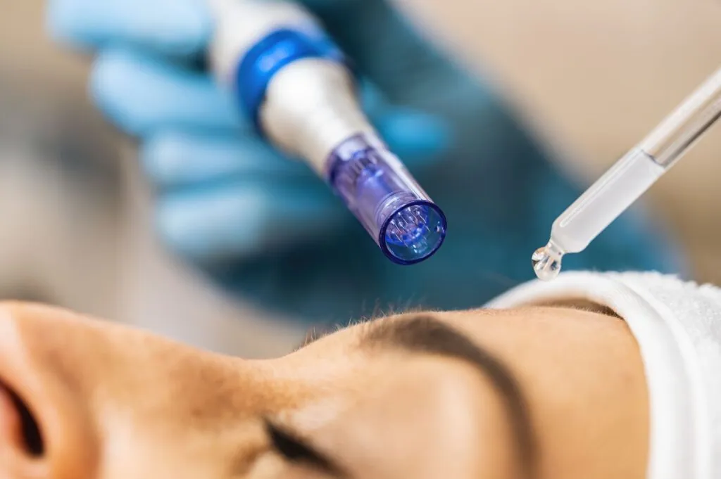 best microneedling resluts from paradise wellness