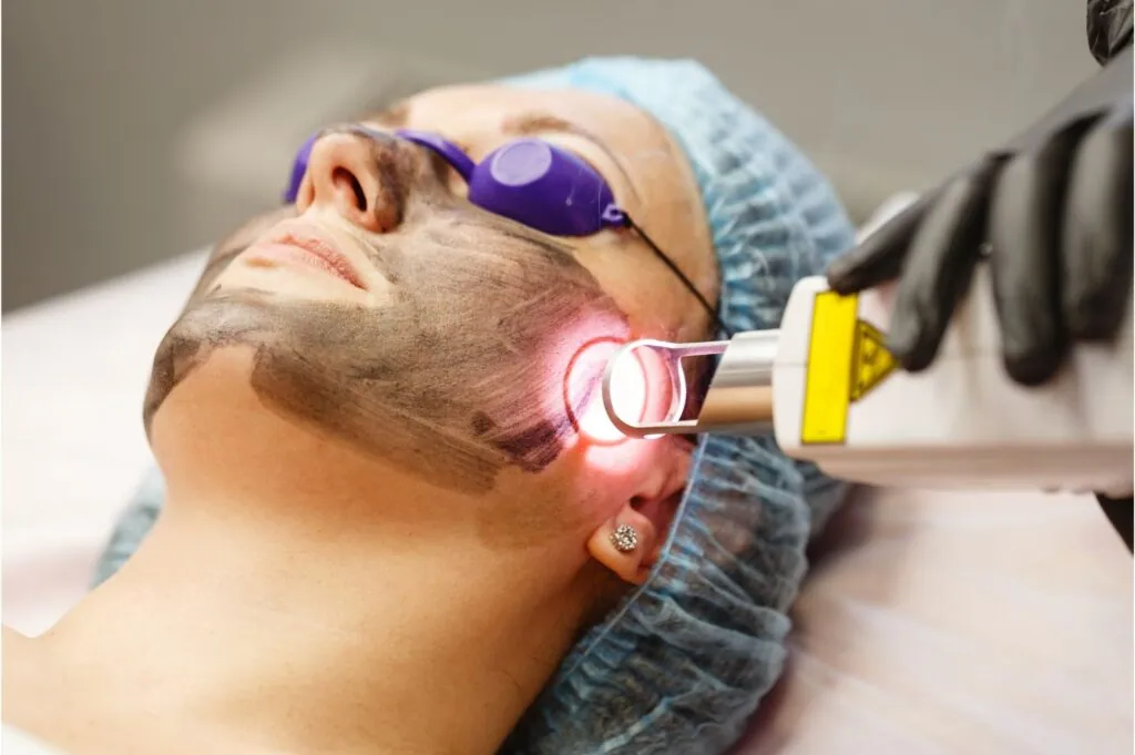 Laser toning for pigmentation treatment at Paradise Wellness