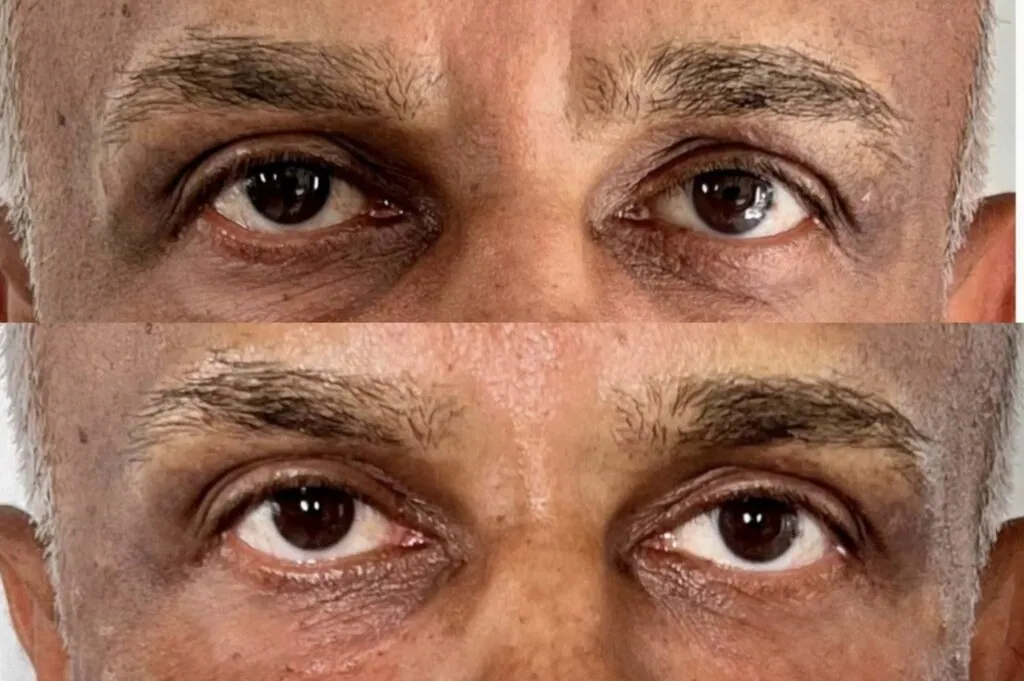 Lumi eyes to work before after