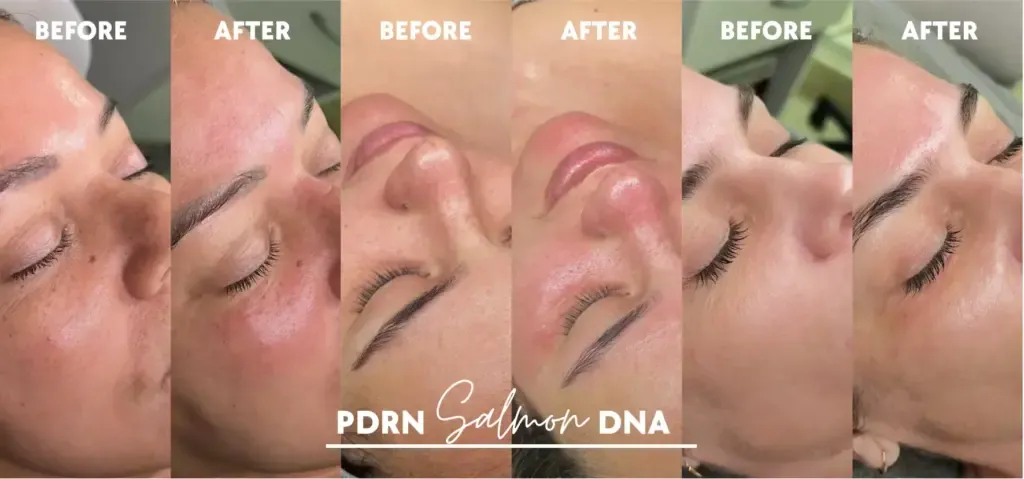 Before and after Salmon DNA PDRN facial results showing improved skin texture, glow, and hydration
