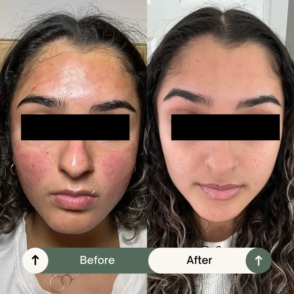 PRF Treatment Result (paradise wellness clinic)