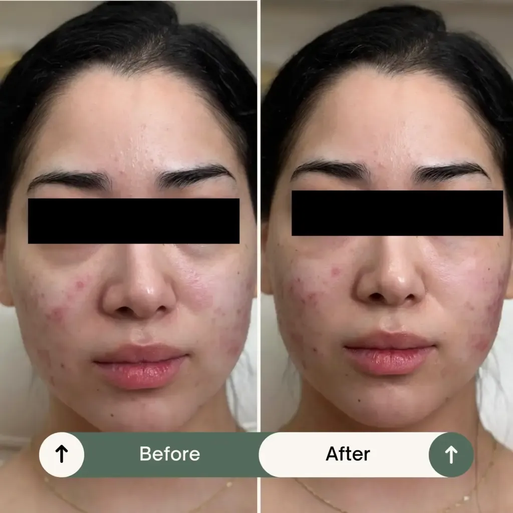 PRF vs PRP see the difference both treatment PRF and PRP 