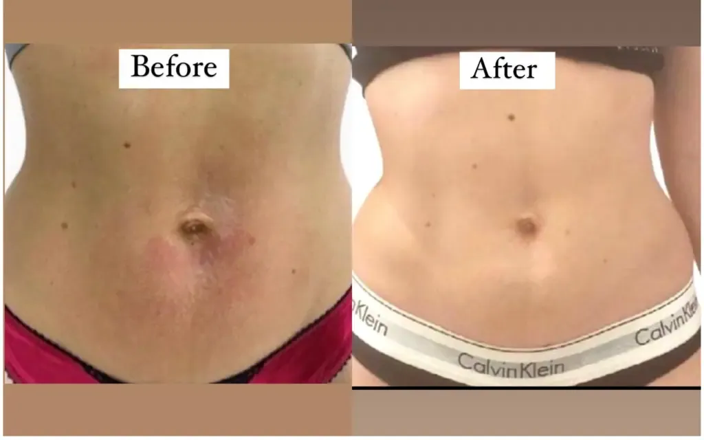 Before after cavitation treatment results in delhi