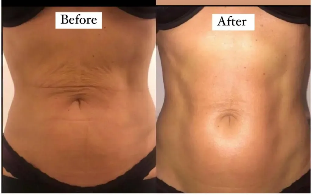 Before and after cavitation treatment showing visible inch loss in Delhi